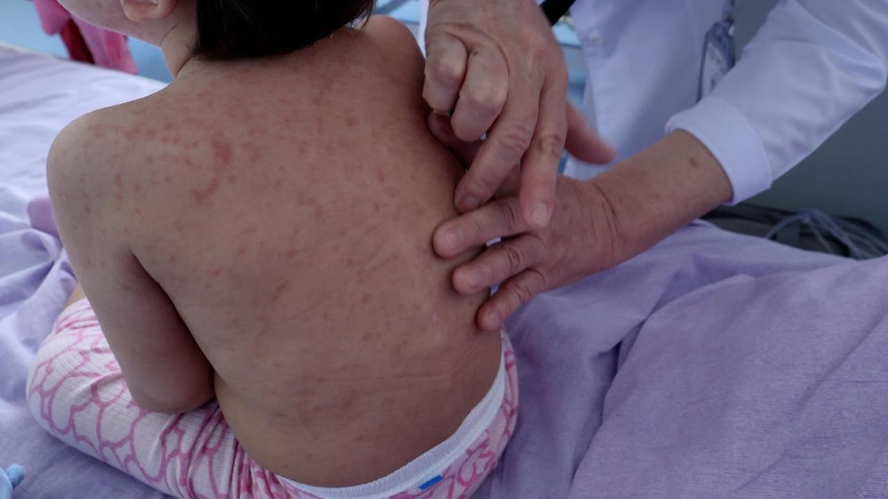 Корь не отступает: главный санврач РК расширил иммунизацию детей и медиков